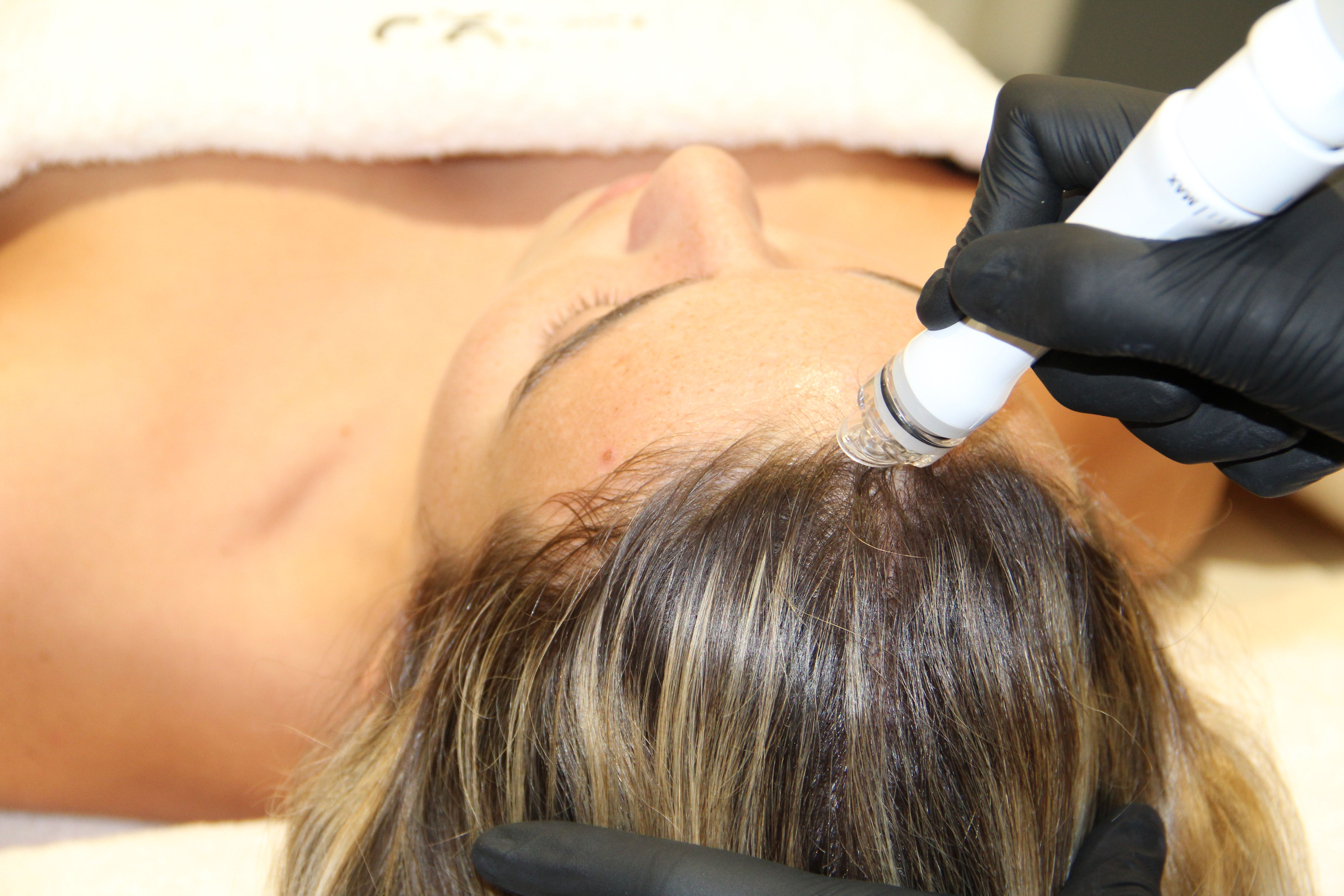 Mesoterapia capilar (dutasterida y vitaminas)