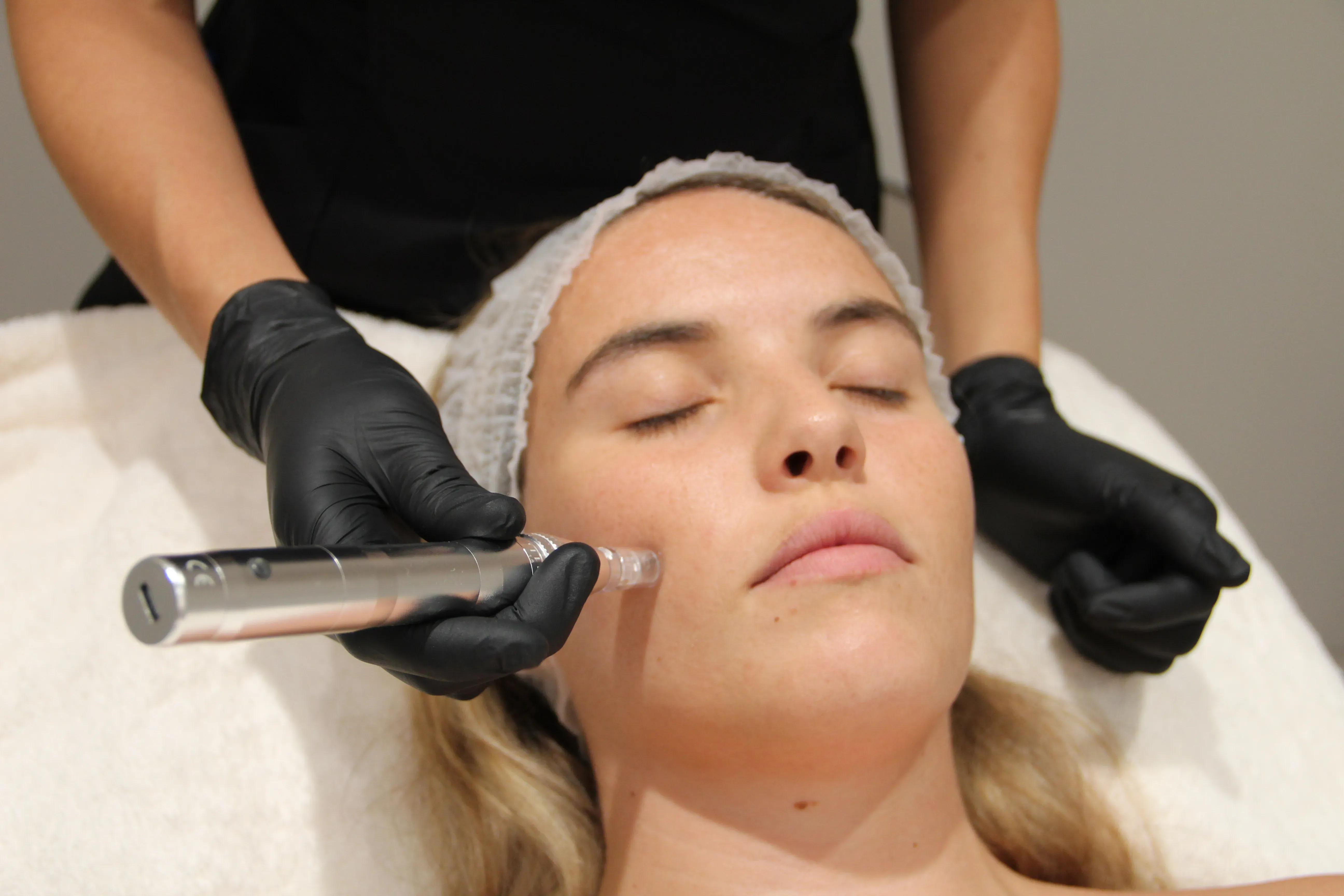 Dermapen (Microneedling)