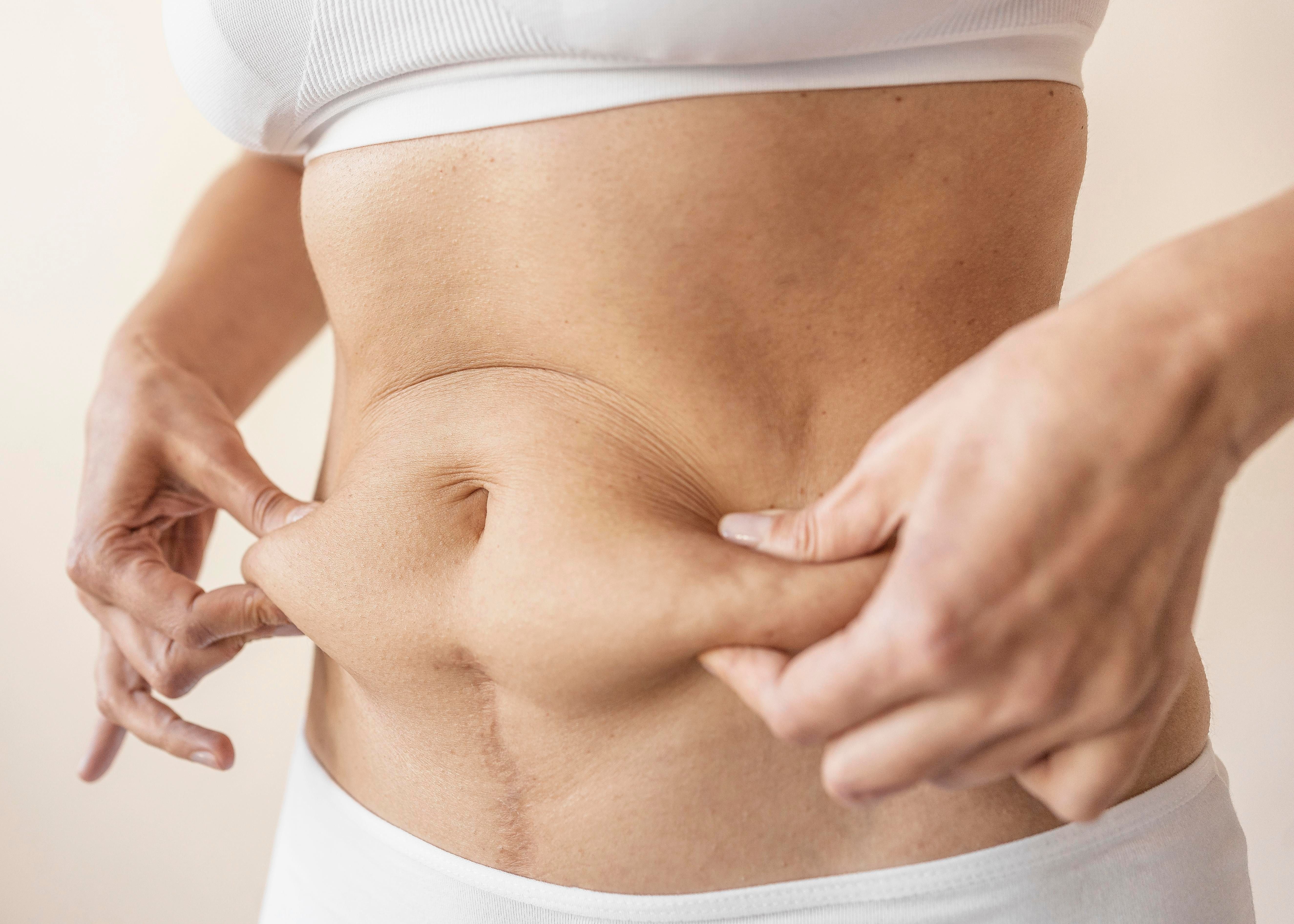 Abdomen terso ( Radiesse, hilos)