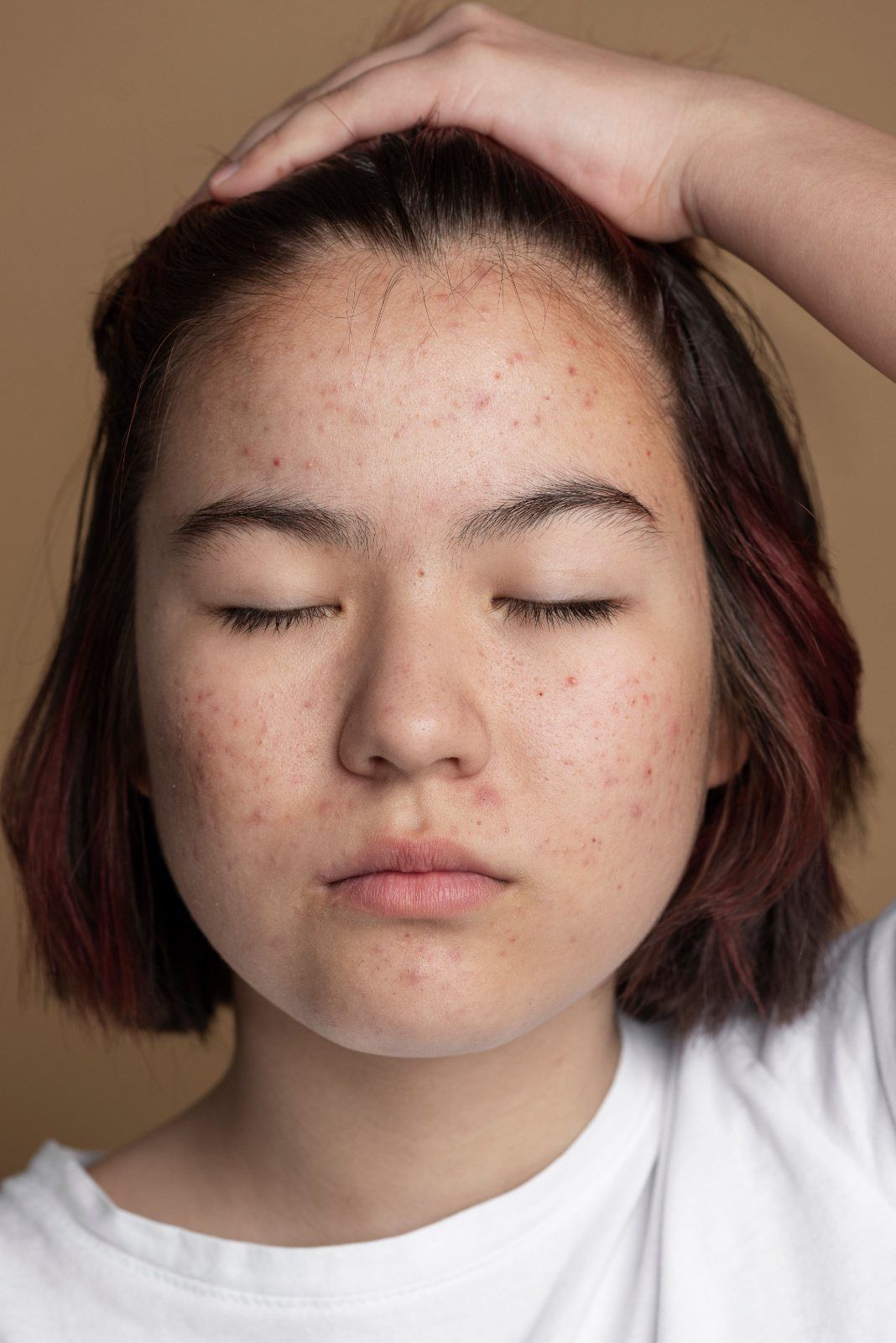 Tratamiento acne juvenil