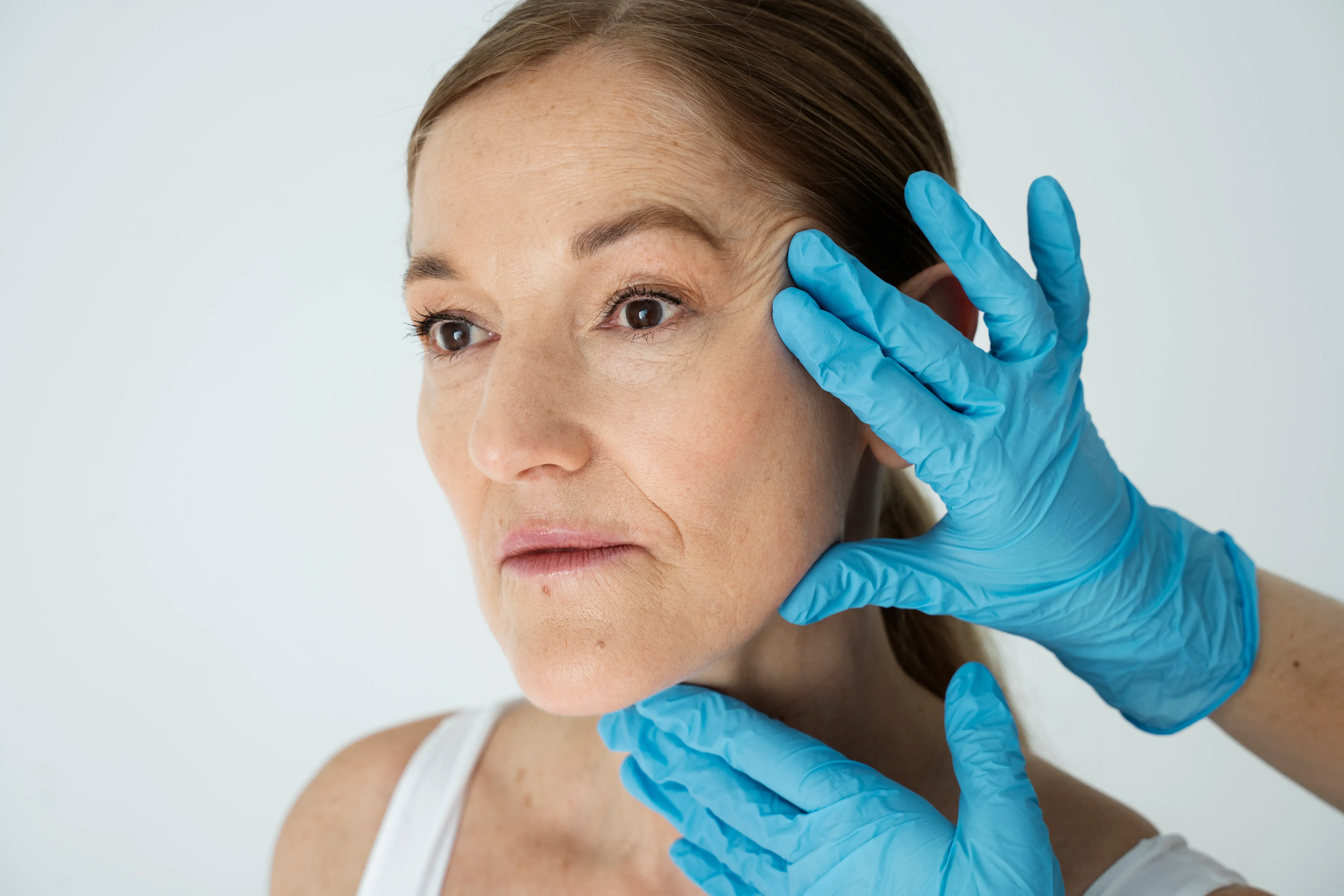Eliminación de melasma