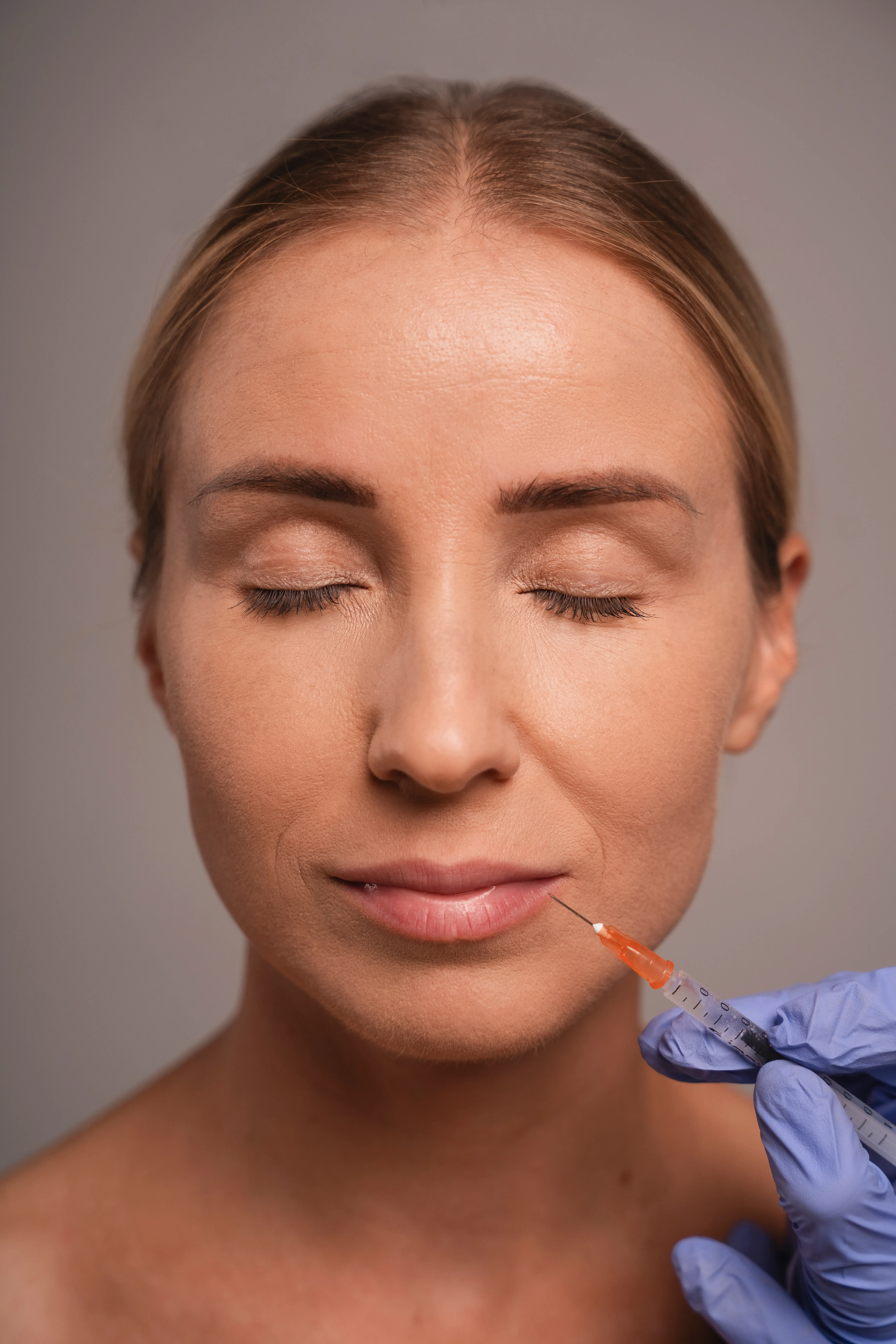 Efecto Lifting sin Cirugía (Sculptra, Radiesse)