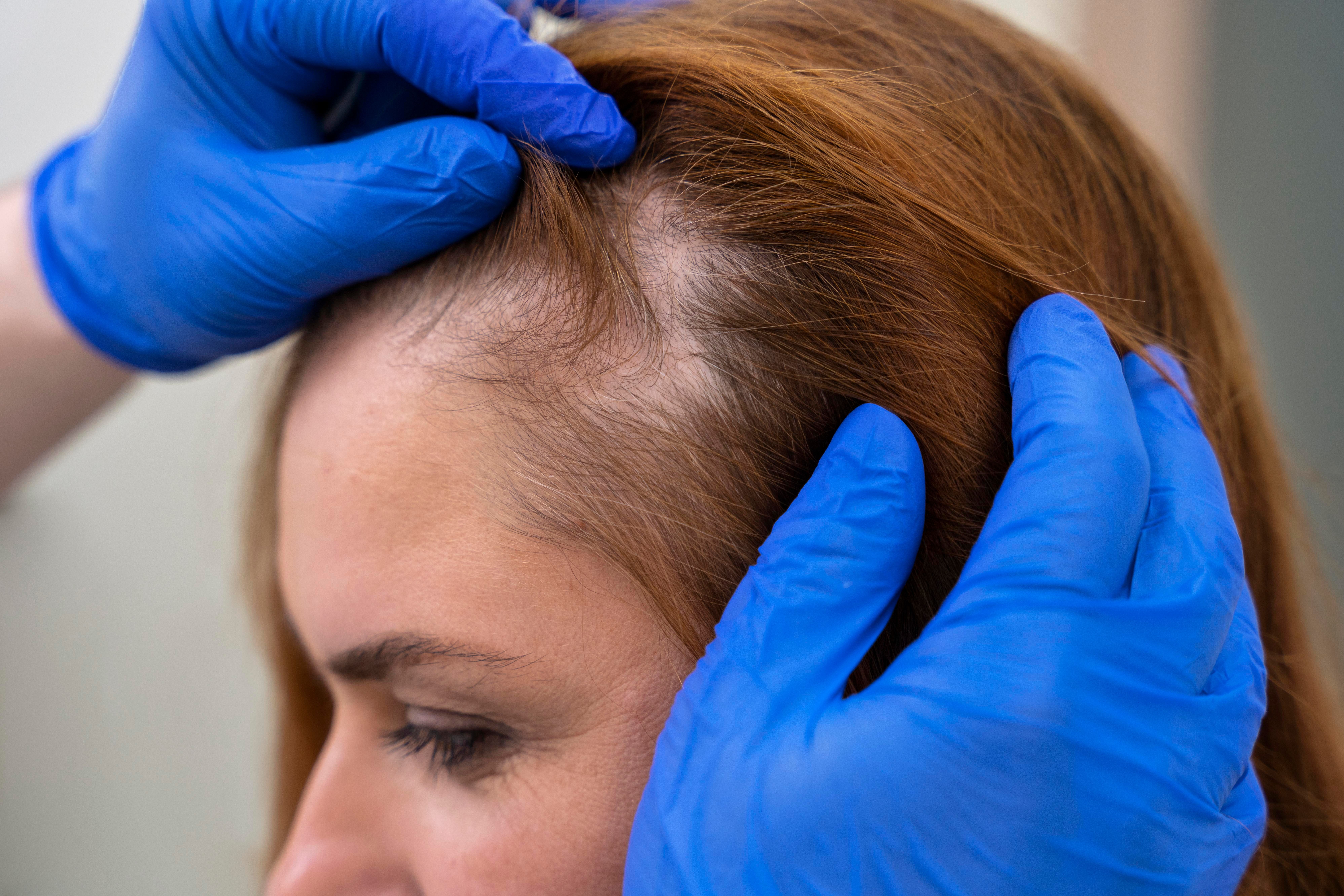 Tratamiento para la Alopecia