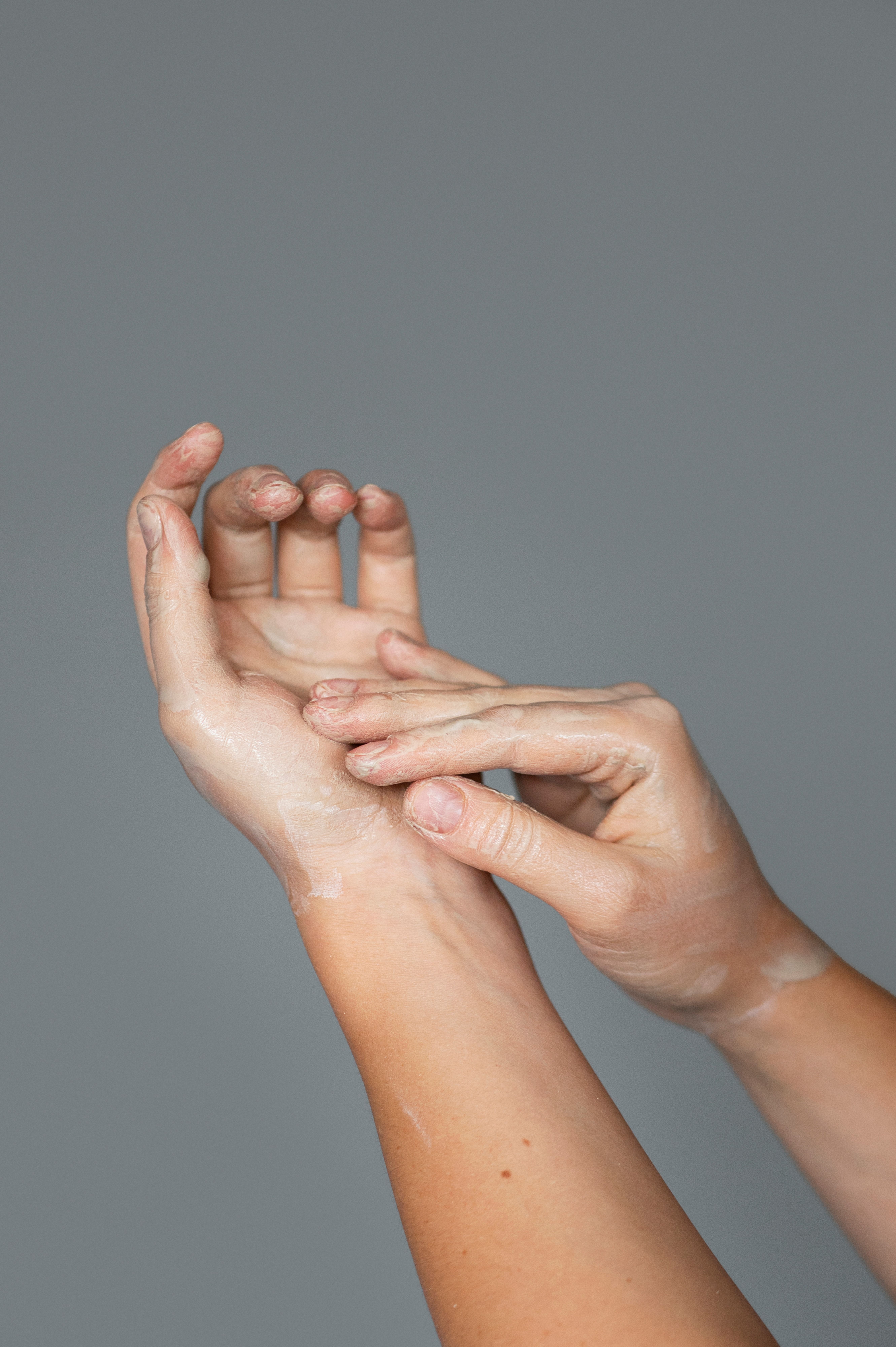 Hiperhidrosis palmar y axilar